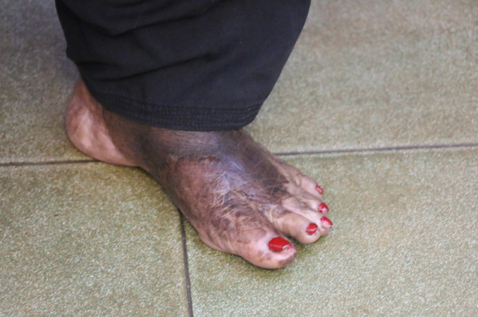 Hot Cooking oil spills down over the leg causing Burns gets completely healed, succeeding the prayers of Grace Ministry in Mangalore in the middle of an ineffective operation.  